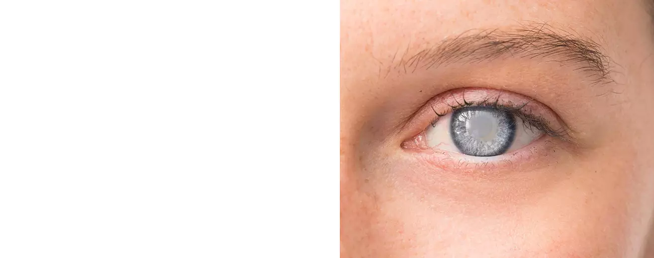 Лечение катаракты