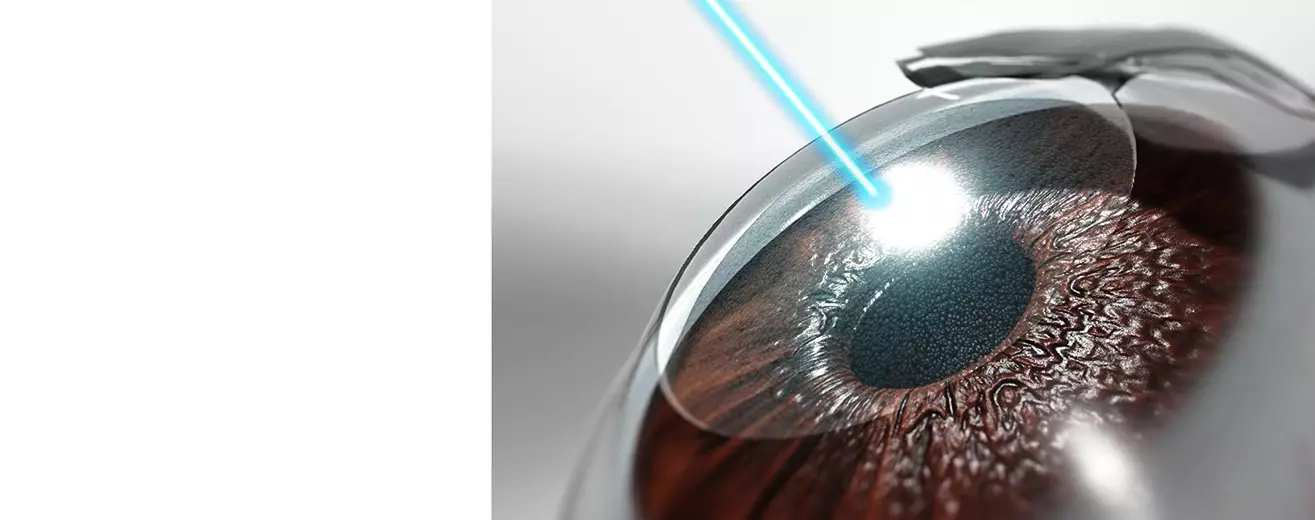Коррекция зрения методом Фемто Ласик (Femto lasik)